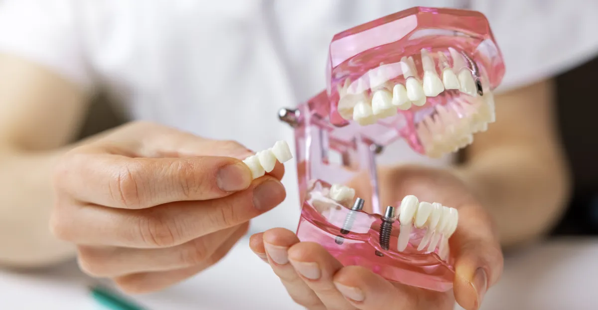 Dental Implants in Fort Myers: What to Expect From Treatment