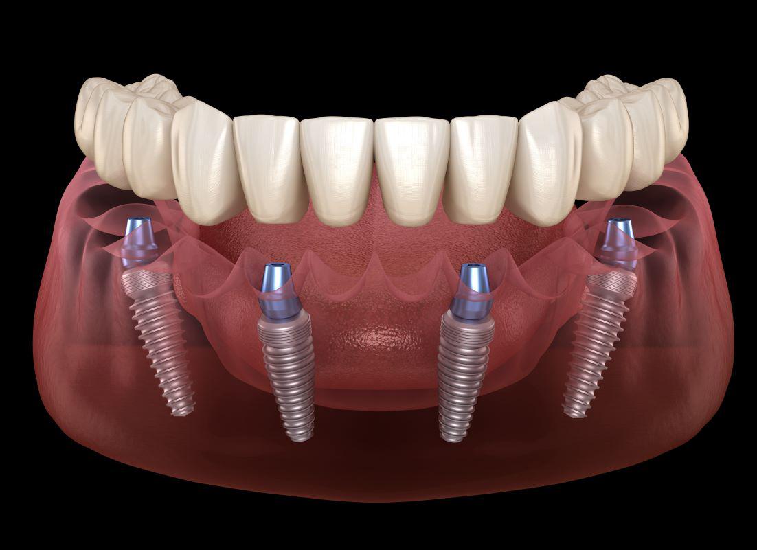 All-on-X Implants Fort Myers, FL