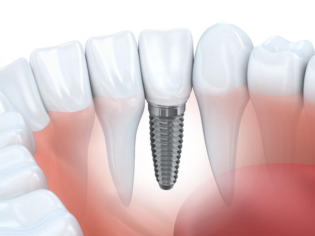Dental Implants Fort Myers, FL