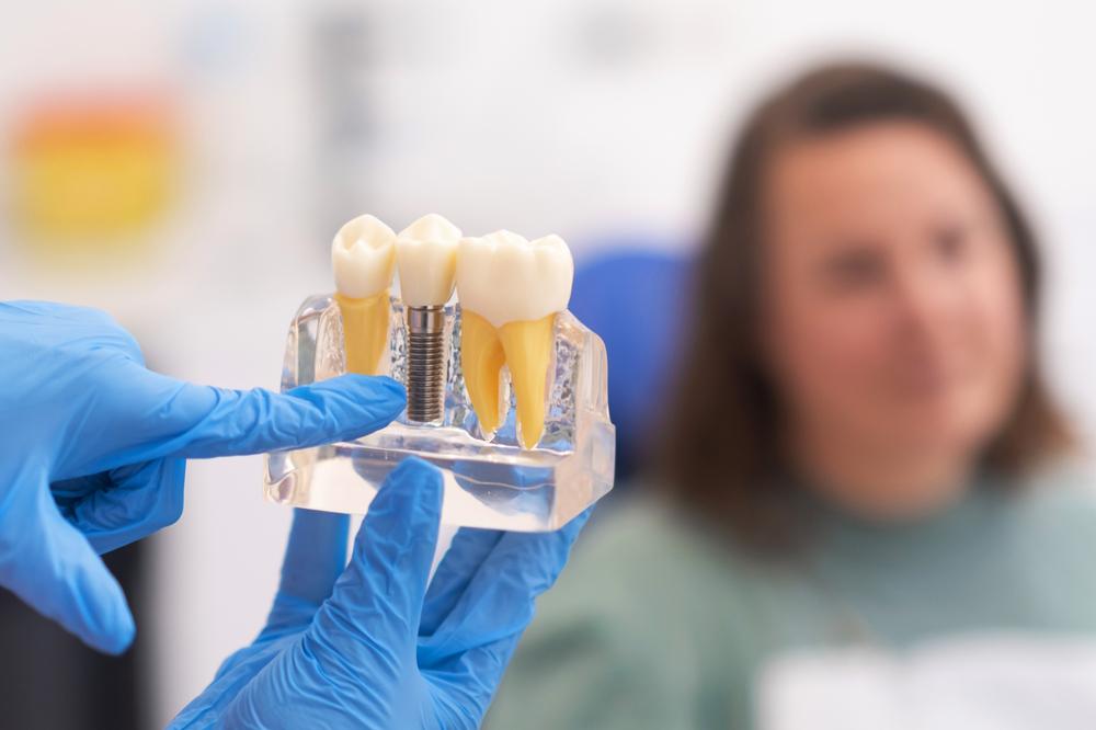 A Complete Guide To Dental Implants