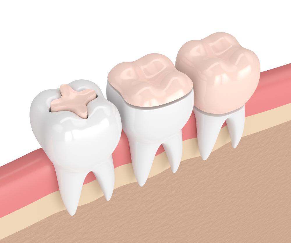 What Are Inlays and Onlays?